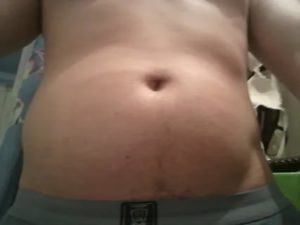 Припухлость в районе пупка