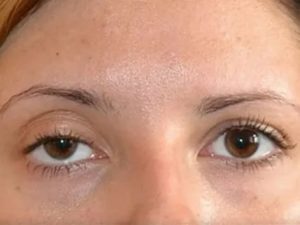 Одно веко ниже другого