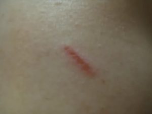 Сыпь в виде царапин