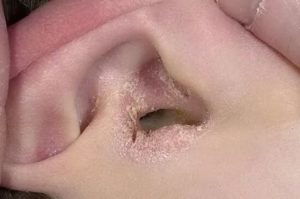 Сухие корочки в ушах