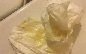 Желтые выделения на 7-8 неделе беременности