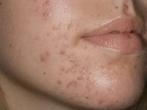 Прыщи в 18 лет