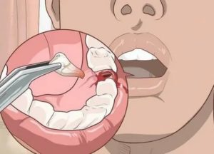 Удалили зуб. То сих пор есть примесь крови в слюне