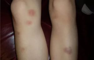 Синяки на ногах у ребенка