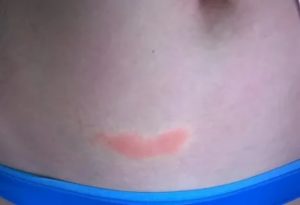 Сыпь над пупком