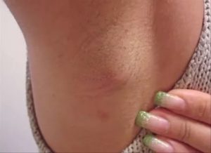 Гидраденит, фурункул или лимфоузел