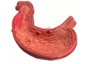 Острая язва антрального отдела желудка