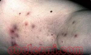 Гидраденит, фурункул или лимфоузел