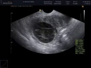 Киста желтого тела или внематочная беременность