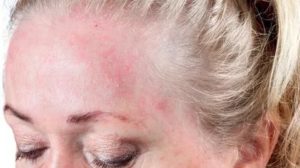 Шелушение кожи на лбу и лице