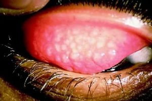 Гонорея во рту