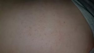 Сыпь на груди животе и спине