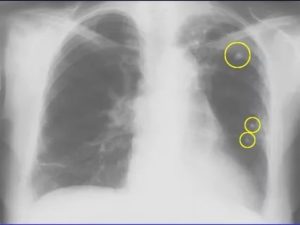 На рентгене выявлены изменения в легких