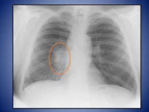 Правый корень расширен при Рентген обследование