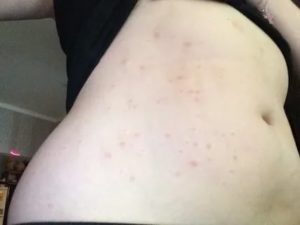 Появились симметричные прыщи по телу