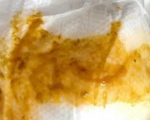 Кал с кровью у 2 месячного ребенка