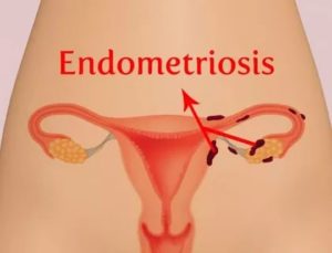 Обильные месячные после лишения девственности