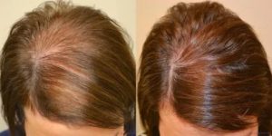 Слабость, выпадение волос, низкий ферритин