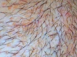 Ранки на лобке