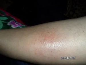 Сильное жжение кожи внизу живота и ляшках до колен