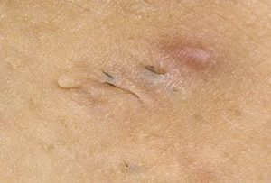 Гидраденит, фурункул или лимфоузел