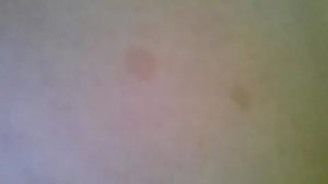 Пятна на теле которые меняют цвет и не передаются