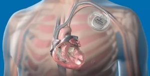 Аппарат кардиовертер-дефибриллятор