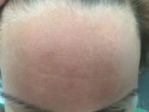 Шелушение кожи на лбу и лице