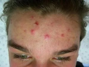 Сколько дней выходит гной из фурункула?