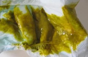 Кал грудничка пахнет уксусом