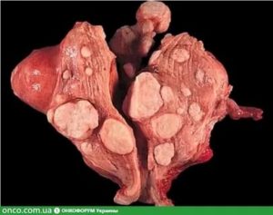 Субфебриллитет миома