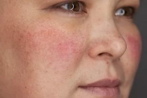 Розацеа-розовые угри