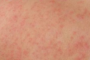 Сыпь на попе у подростка