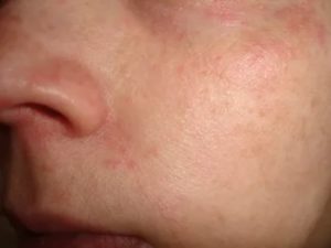 Зудящие высыпания на лице