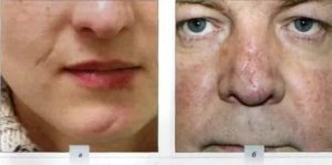 Можно ли иссечь атрофический рубец на носу?