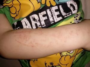 Пятна на теле похожи на засос