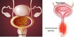 Цистит и запах
