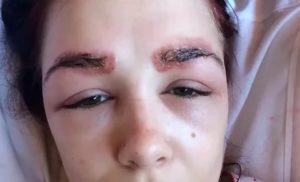 Аллергия на краску для бровей