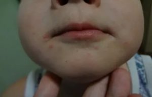 Температура и сыпь на лице