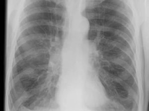 На рентгене выявлены изменения в легких