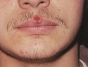 Сифилис ли это? Фото