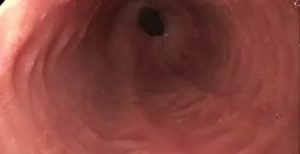 Рефлюкс эзофагит 1степени, поверхностный гастрит и деуденит