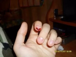 Отрезало половину подушечки пальца