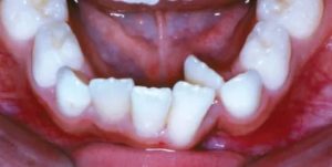 Удалили клык