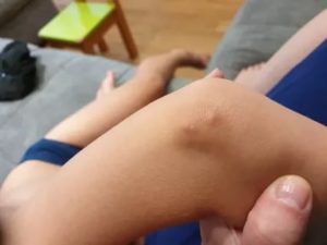 Прыщ на локте. Очень болит