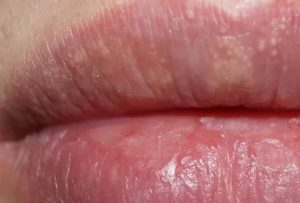 Пигментация на половой губе