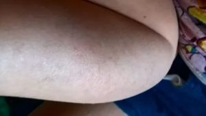 Прыщи на бицепсе переходят на руки ниже