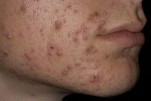 Прыщи в 18 лет