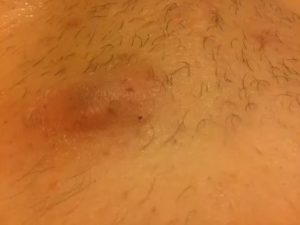 Покраснение и рубцы в паху