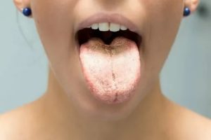 Белый налет на языке, диарея, кариес